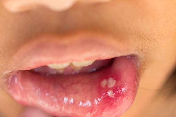 mouth-ulcer