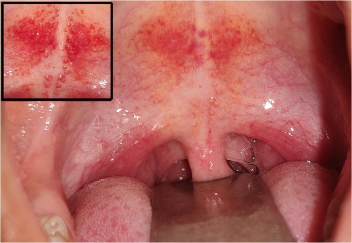 red spots in mouth